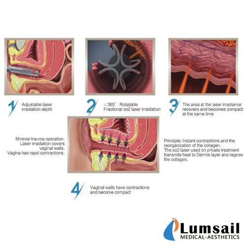 Gynecology CO2 Fractional Laser Machine For Vaginal Tightening