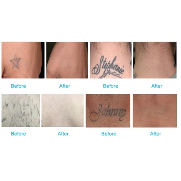 P3 Tattoo Removal Q Switch Nd Yag Pigment Removal Carbon Peeling Laser Machine Age Spots Removal For Beauty Salon Use