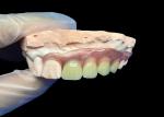 Invisible Flexible Partial dentures for Comfortable Secure Fit and Natural