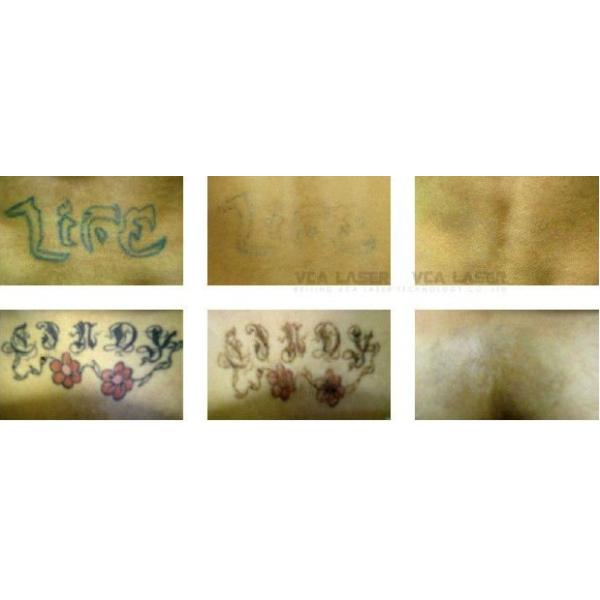 OEM design tattoo removal machine portable