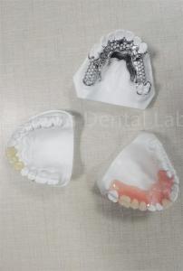Long Lasting Flexible Removable Partial Denture Easy Cleaning Replace Missing Teeth