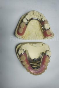 PEEK Upper Removable Partial Denture Requires Regular Maintenance