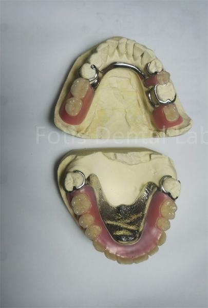 Quality PEEK Upper Removable Partial Denture Requires Regular Maintenance for sale