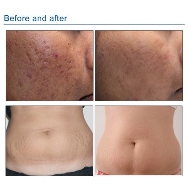 Fractional Micro Needle Rf Skin Needling Machine For Face And Body