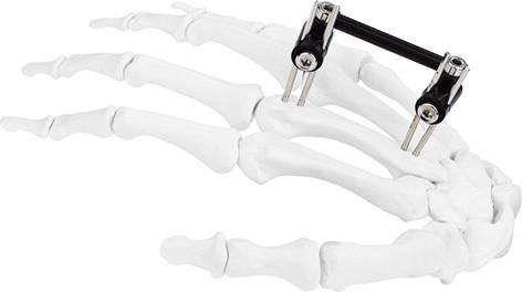 Quality Hand Bone Pin Stent Radius Mini External Fixator Ortho Combined Type for sale