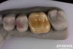 Medium Translucency Emax Inlay Onlay Easy Cleaning And Non-toxic Biocompatibility In Materials