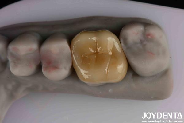 Quality Medium Translucency Emax Inlay Onlay Easy Cleaning And Non-toxic Biocompatibility In Materials for sale