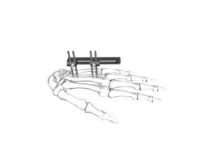 Buy cheap Metacarapale External Fixation System Sliver / Black Color Long Lifespan product