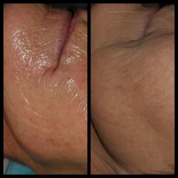 Sincoheren Skin Tightening RF Machine / Microneedling Radio Frequency Beauty Machine