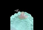 Lightweight and Comfortable Nesbit Flexible Denture for Single Tooth Replacement