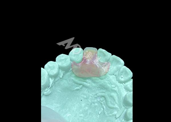 Quality Lightweight and Comfortable Nesbit Flexible Denture for Single Tooth Replacement for sale
