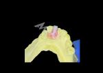 Nesbit Flexible Partial Denture for Comfort and Durability in Tooth Replacement