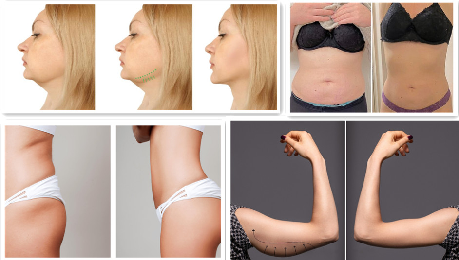 Weight Loss Injection Lipolysis Solution For Fat Dissolving