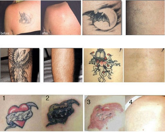 tattoo removal machine-treatment.jpg