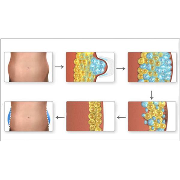COOL WAVE Cryotherapy Slimming Machine /Fat Freezing Cryolipolyse Equipment With Shockwave Cellulite Removal