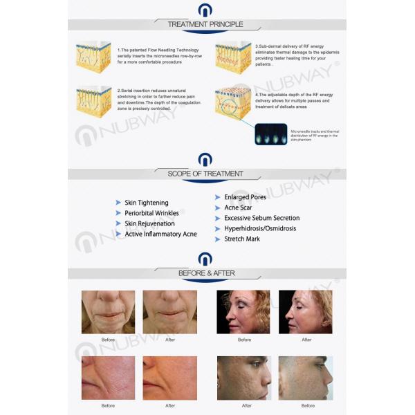 Portable/home use Fractional RF Microneedle Beauty Equipment Device for skin rejuvenation with discounting now