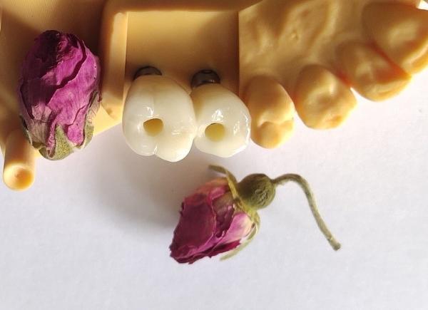 Quality Cemented Implants Crowns Bridges for sale