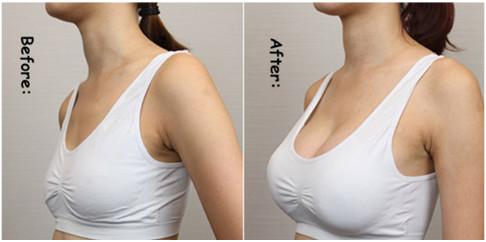 Quality Injectable Hyaluronic Acid Ha Filler For Lips Facial Wrinkle Breast Enlargement Buttock Filler Injections for sale