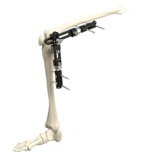 High Quality Orthopedic Surgical Instruments Knee Joint External Fixator External Fixation Orthopedic Surgical Instrumen