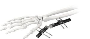 Orthopedic Wrist External Fixator Standard Single sided Integrated