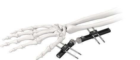 Quality Orthopedic Wrist External Fixator Standard Single sided Integrated for sale