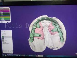Tooth Restoration Denture Design Studio Expertly Crafted For Your Satisfaction
