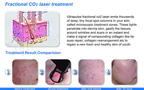 rf fractional co2 laser.jpg