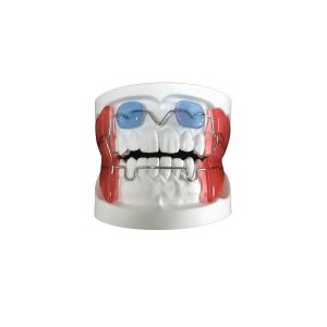 Buy cheap Fixed Appliance Dental Functional Appliance Good Fixation Adequate Anchorage product