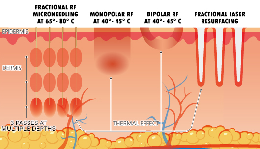 ADVANTAGES OF RF MICRONEEDLING VS LASER SKIN RESURFACING - NU Image