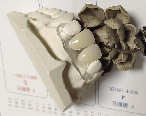 Quality Soft Elastic Nylon Trushine Invisible Denture for sale