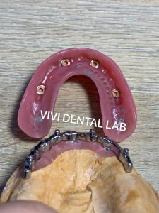 Buy cheap Dental Bar Implant Assisted Dentures High Esthetics Good Fit with attachments product
