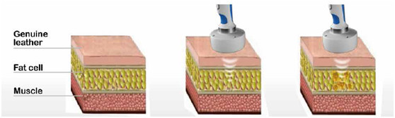 HIFUSHAPE hifu machine treatment principle.jpg