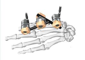 Buy cheap Stable External Fixation System Dissection IV Φ5- Children’S Metacarpale Fixation product