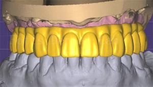 Professional  3shape Crown Design Excellent Performance And Durability