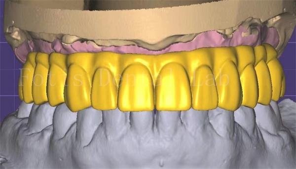 Quality Professional  3shape Crown Design Excellent Performance And Durability for sale