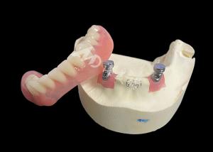 Buy cheap Implant Locator Bar Overdenture Solution For Enhanced Chewing And Speech product