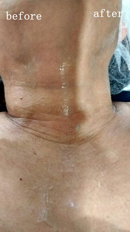 Skin Rejuvenation Machine Face Wrinkle Removal Machine Jowl lifting
