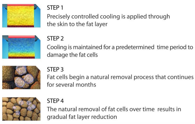 3 Cryo handles fat freezing cryolipolysis machine for fat cell freezing treatment