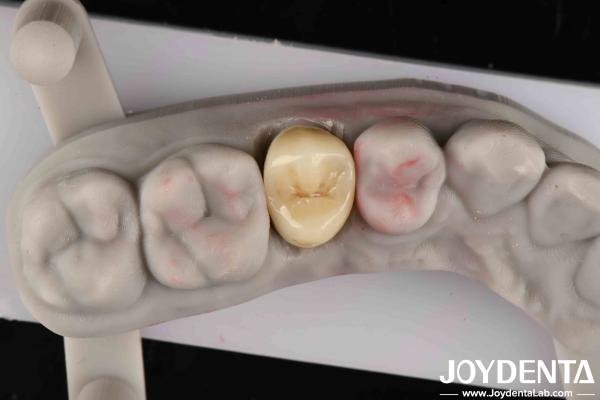 Quality Fracture Toughness 9 MPa·m1/2 High Aesthetics High Resistance To Wear Full Zirconia for sale