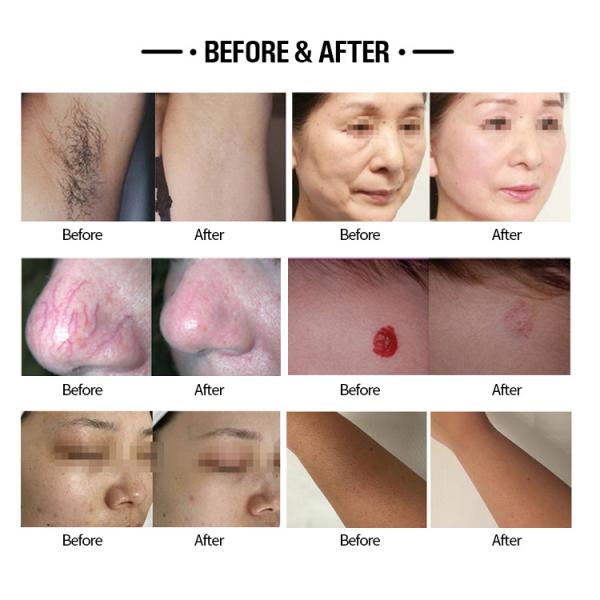 Advanced Alexandrite Laser Machine With High Resolution Screen