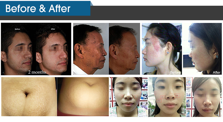 Fractional CO2 Laser Vaginal Tightening Machine , Air Cooling CO2 Laser Beauty Equipment