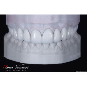 Buy cheap Natural Hollywood White Veneers product