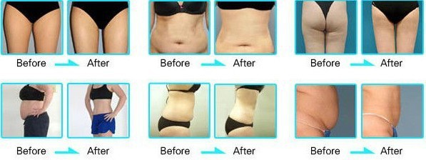 Multi - handles Vacuum Cavitation RF Cryolipolysis Slimming Machine For Body Shaping whole body slimming