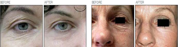 Periorbital Wrinkle