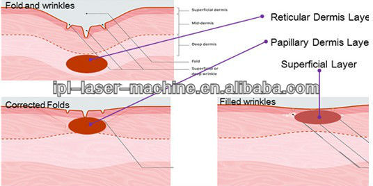 Fractional RF Microneedle Machine.jpg