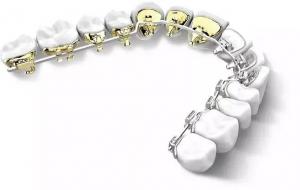 China Dental BracesFixed Orthodontic Appliances Side Back Invisible Lingual Braces Aesthetic Natural on sale