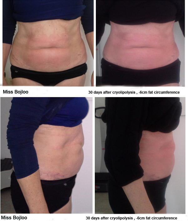 3 Cryo handles fat freezing cryolipolysis machine for fat cell freezing treatment