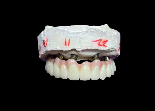 Quality Dental Implant Supported Fixed Full Arch Dentures for a Permanent, Stable, and Natural-Looking Solution to Missing Teeth for sale