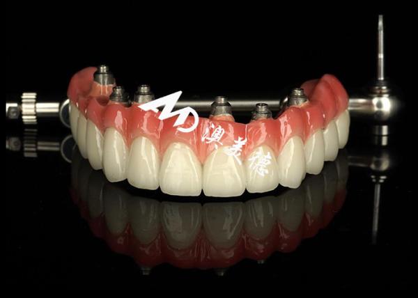 Quality Customized Dental Implant supported dentures Crown Bridge For Missing Teeth Maintenance for sale