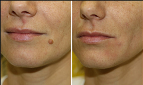 Mole Removal CO2 Fractional Laser Machine , CO2 Laser Machine For Acne Scars